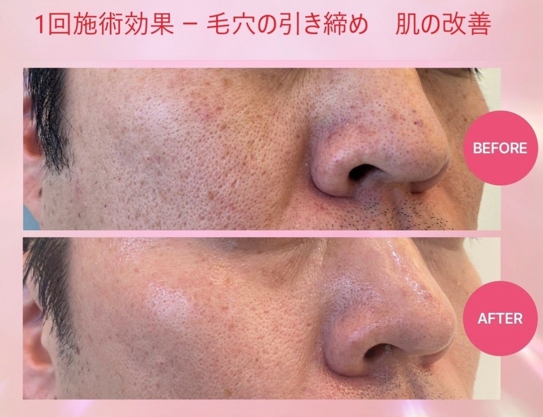 世界初のプラズマ登場！！本気の肌質改善へ | 脱！老け顔✨Natural