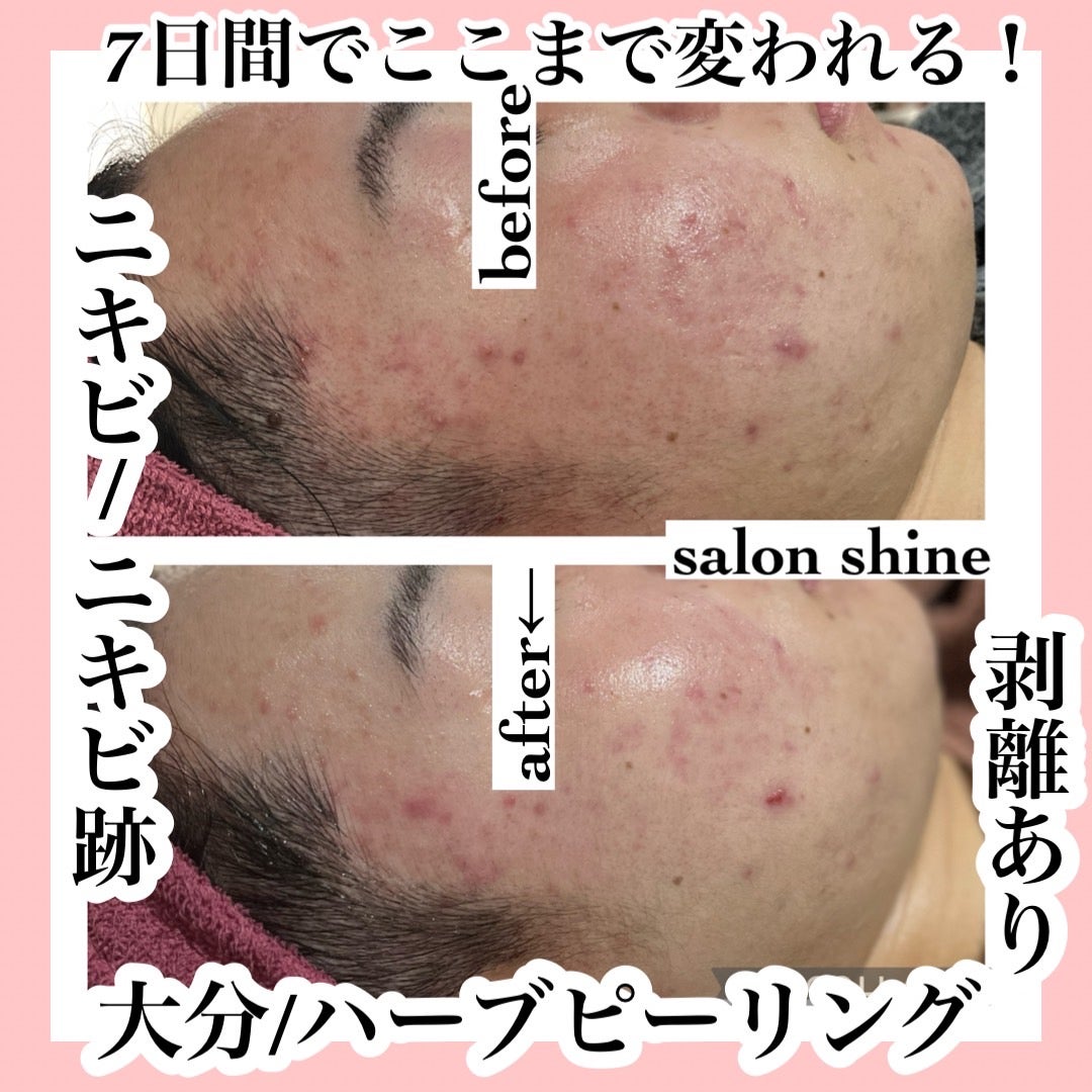 12月31日まで【大特価年末セール】剥離ありハーブピーリング20回分