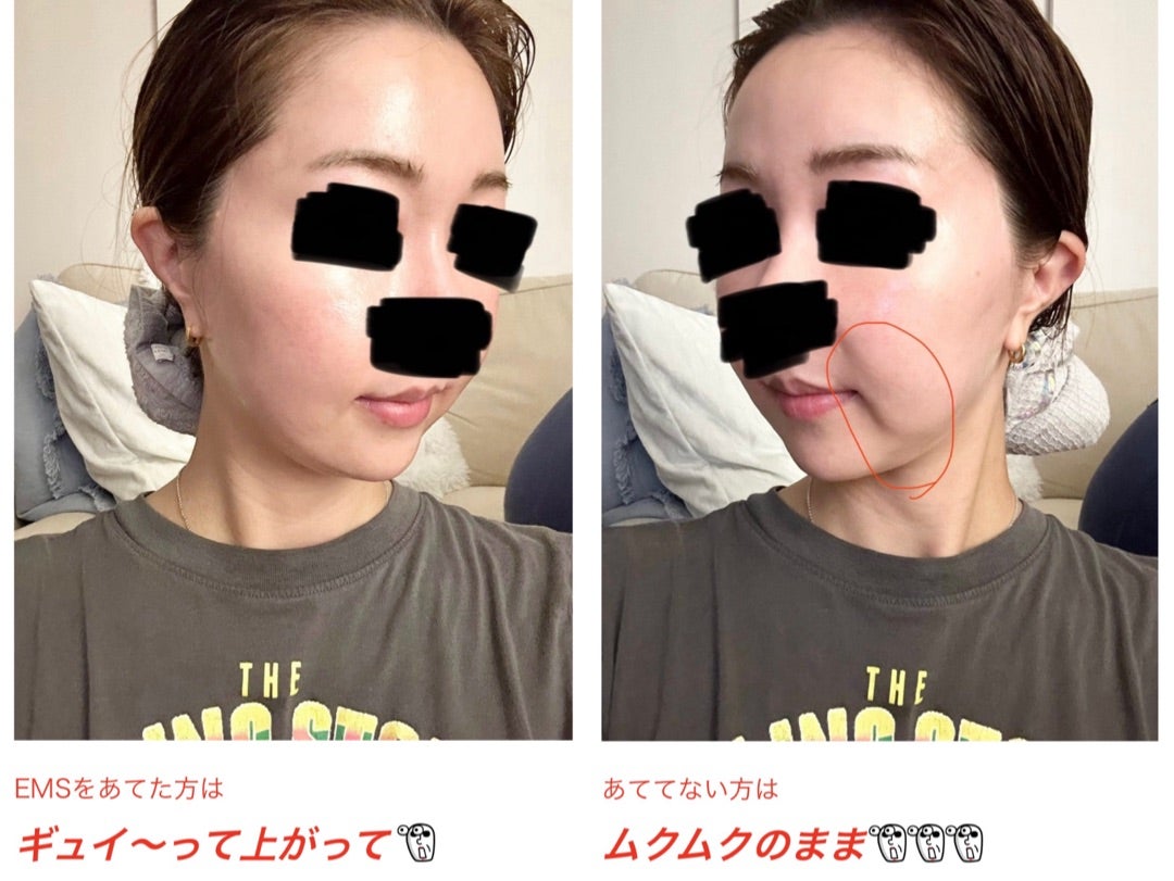 美顔器でのリフトアップ効果について | hana1143の美容徒然