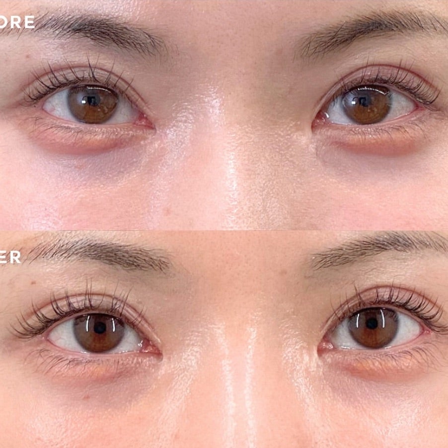 レーザーで青グマ改善✨目の下のたるみ、クマ、色ぐまは「フォトナアイ