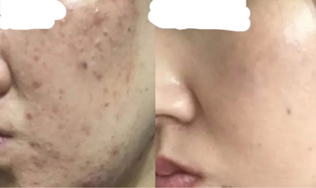 限定セット《剥離あり》皮むけありハーブピーリング4〜8回分国産農薬不使用★取説付